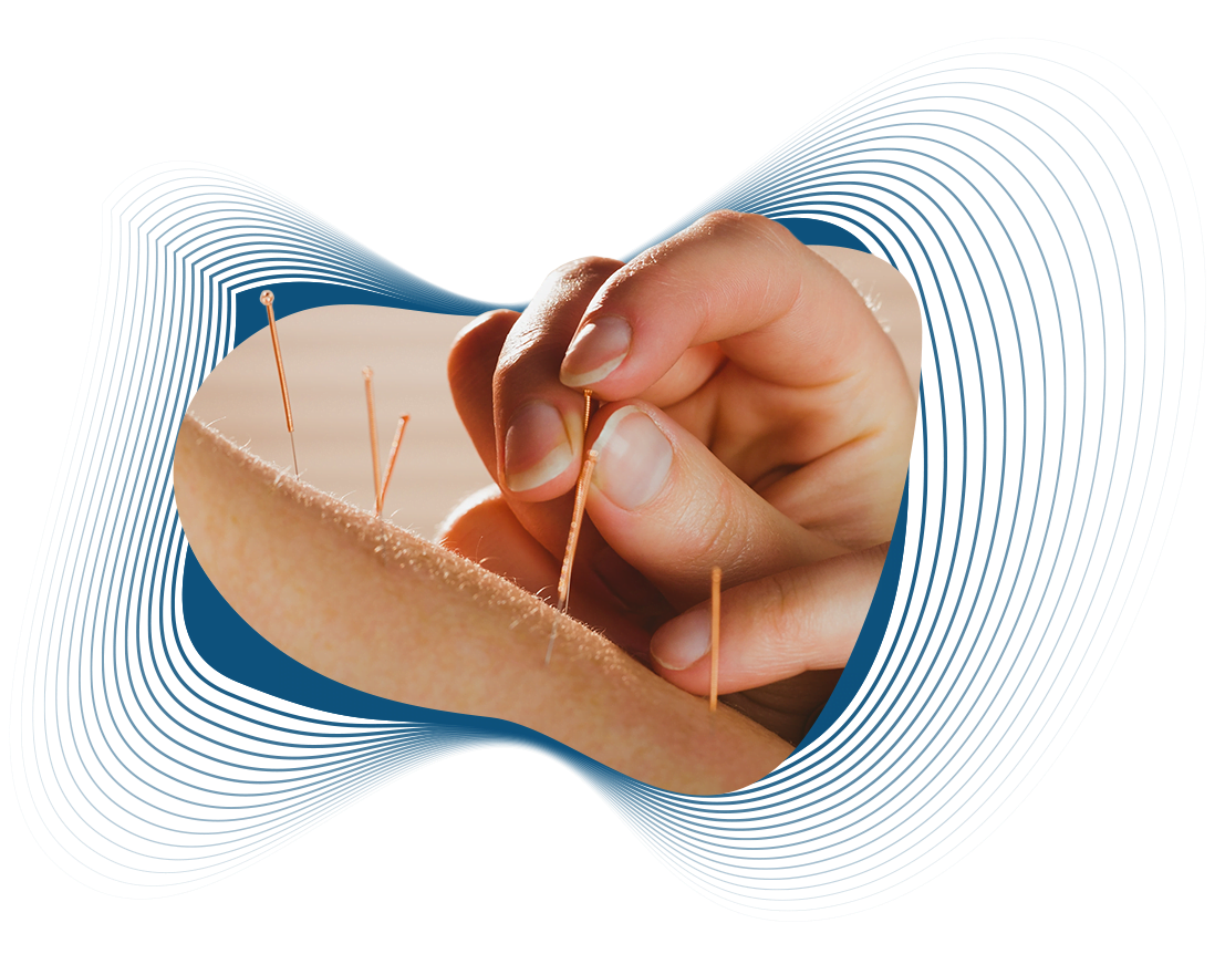 Acupunture